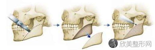 截骨手术示意图