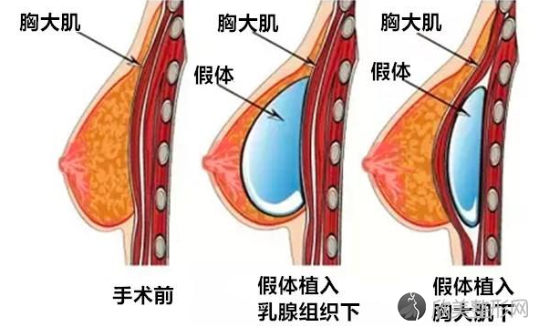 假体隆胸手术原理