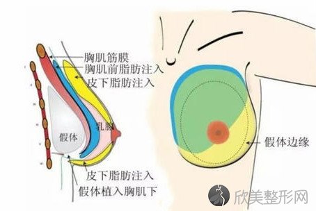 假体隆胸结合自体脂肪隆胸