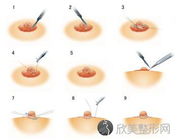 乳头凹陷矫正手术