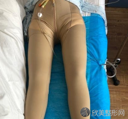 重庆时光医院吸脂瘦大腿