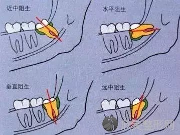 这些智齿是需要拔掉的！