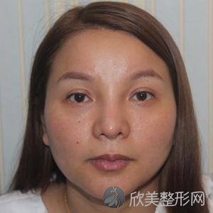 北京联合丽格较好医疗美容医院吴焱秋怎么样?自体脂肪面部填充顾客反馈对比