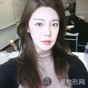 北京联合丽格较好医疗美容医院王瑞晨怎么样?自体脂肪面部填充附上医生案例