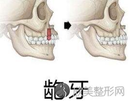 严重龅牙不仅影响美观，更影响咬合引发各种问题，牙医教你怎么治！