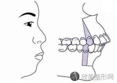 严重龅牙不仅影响美观，更影响咬合引发各种问题，牙医教你怎么治！