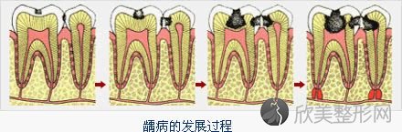 睡前不刷牙，原来危害这么大