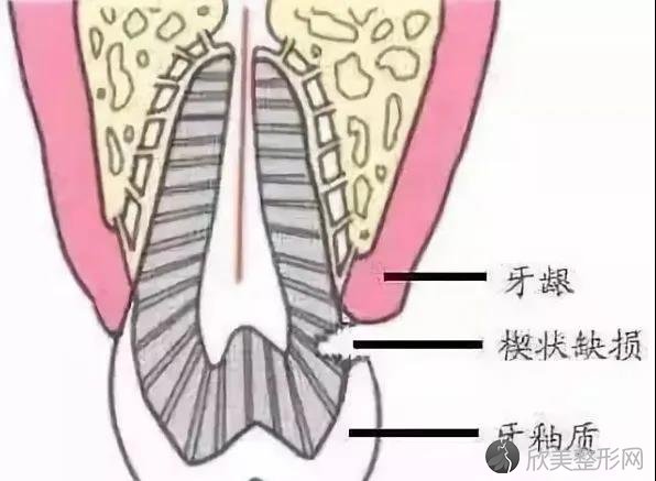 刷了几十年牙，没想到这些习惯等于在毁牙！