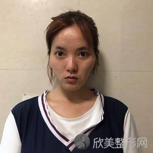 北京新星靓李伟民医生怎么样?自体脂肪面部填充顾客术后反馈案例-收费标准