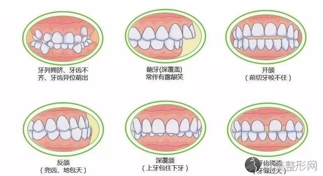 牙齿不齐不是小事，会影响你一生的颜值！