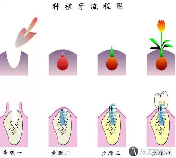 专业口腔医生为您详细讲解种植牙手术前后应注意的事项！