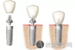 牙齿种植是如何种牙的？