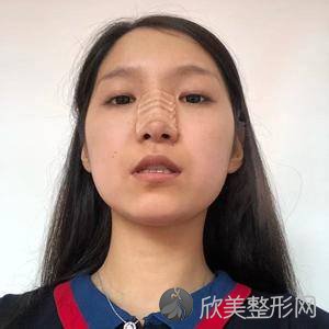 南京韩辰医疗美容整形医院晏义兵做自体脂肪隆鼻手术怎么样？附医生简介-自