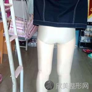 包头联合丽格医疗美容门诊部韩金柱做大腿吸脂怎么样？附医生简介-大腿吸脂