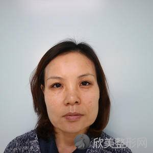 池州哪家医院做面部提升手术较专业？丽美、伊尚美、立新等实力在线比较!！