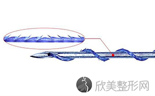 常州做线雕提升术后效果维持多久？