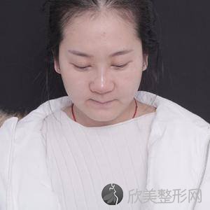 乌鲁木齐哪家医院做自体耳软骨隆鼻效果好？排行榜新疆天山医院、陈频、乌鲁