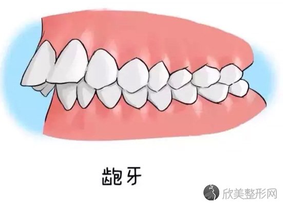 骨性龅牙的手术风险大吗