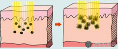 厦门做激光祛斑手术有副作用吗