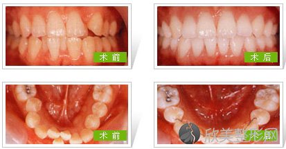 矫正牙齿后的护理方法都有哪些呢