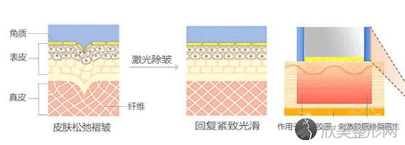 西安面部除皱失败了怎么修复