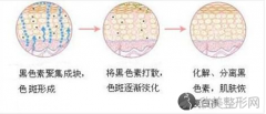 上海激光去斑会有后遗症吗