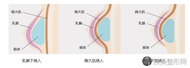 苏州自体脂肪隆胸会有风险吗