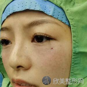 天津艺姿蔓医学美容门诊部陈昊东做激光去眼袋怎么样？附医生简介-激光去眼