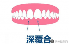 深覆合前突怎么矫正