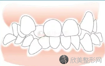 牙冠和牙套有什么区别