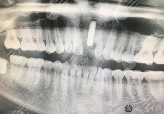 北大口腔医院种植牙案例