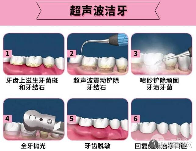 上海同口名雅口腔讲解牙齿美白