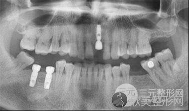 种植牙案例