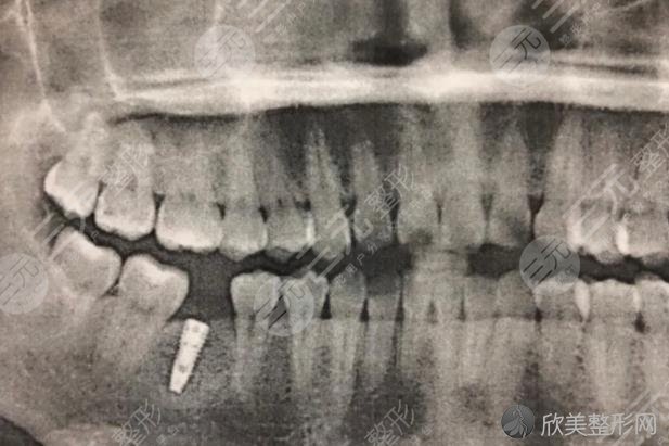 乌鲁木齐口腔医院种植牙经历分享