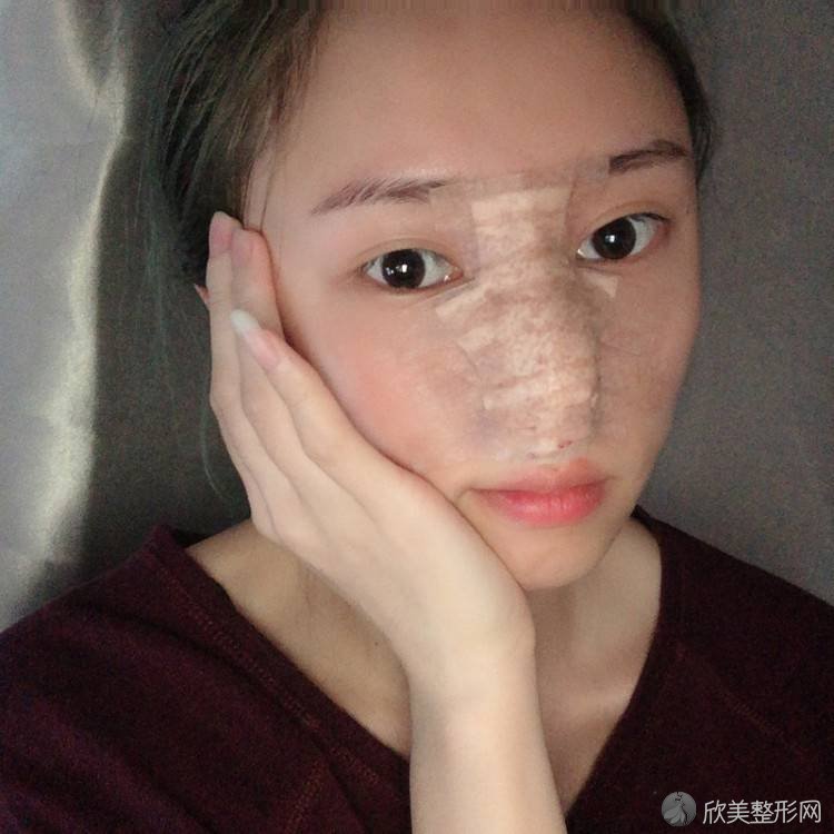 广州哪家医院做鼻尖靠谱？盘点前三排行榜!宁美、青花瓷星和、广州长泰医院