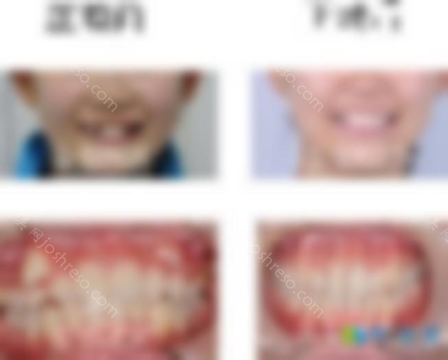 省钱！请查看上海振威口腔暑期牙齿矫正活动，隐适美口扫免费