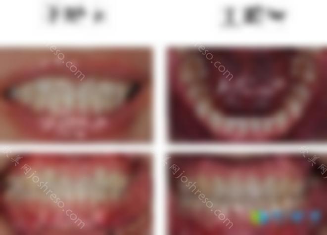 省钱！请查看上海振威口腔暑期牙齿矫正活动，隐适美口扫免费