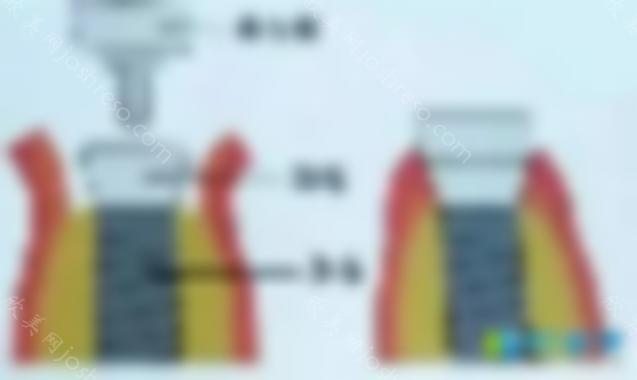 问iti种植体瑞锆和钛锆的人首先要了解清楚Roxolid钛锆种植体