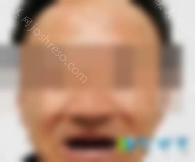 无锡通善口腔怎么样？王杏松院长立即种植牙案例及效果反馈