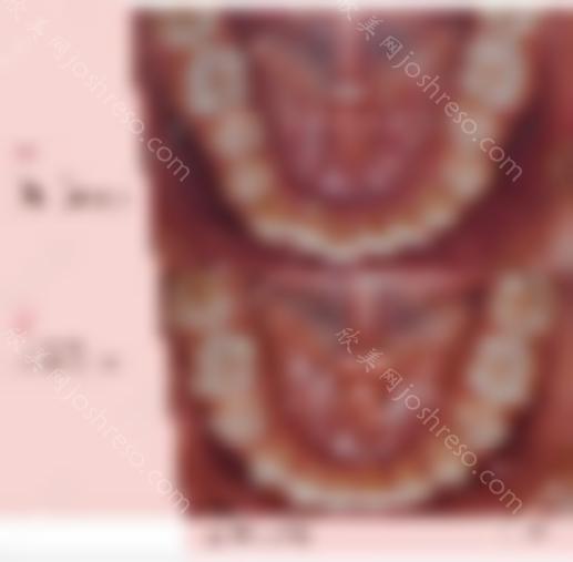 骨性前突隐适合拔牙 骨钉矫正反击，上海正畸医生王芳真厉害