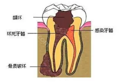 牙髓炎吃了布洛芬睡一觉就好了，还需不需要去医院治疗？