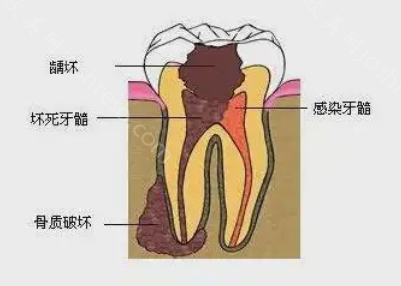 如果出现了这样的智齿牙根腐烂图片，请你及时的去拔除！