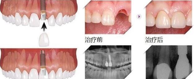 种植牙十大品牌你了解吗？稳定性好，固定能力强的是哪些？