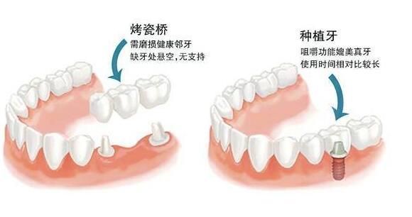 德国种植牙品牌及价格是多少呢？德国阿斯特种植体、费亚丹种植体介绍！