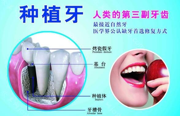 韩国奥齿泰种植牙质量怎么样呢？韩国奥齿泰种植牙齿的优点是什么呢？