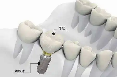 牙齿种植体十大排名，还不知道如何选择种植体赶紧收藏起来！