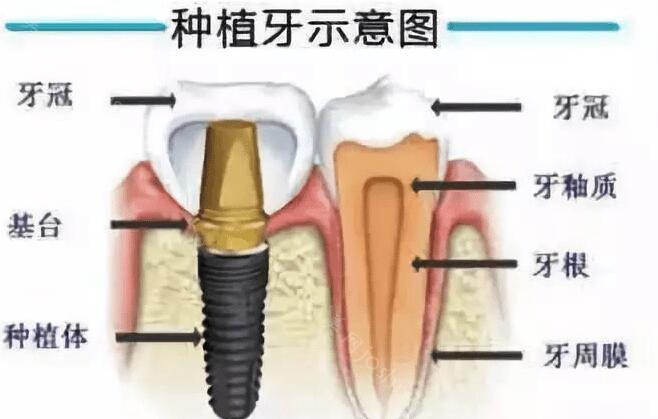 登腾种植体和奥齿泰哪个好？优势都是什么呢？请进来了解！