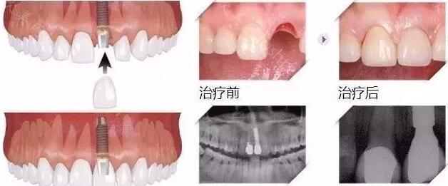 满口种牙多少钱呢一颗牙齿的价格5000多元，这到底靠不靠谱呢？