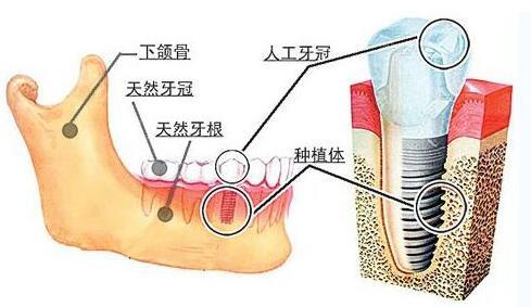 满口种牙多少钱呢一颗牙齿的价格5000多元，这到底靠不靠谱呢？