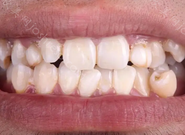 闭嘴时上牙包住下牙正常吗?如何矫正呢?